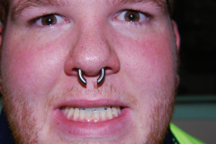 6g-titanium-septum