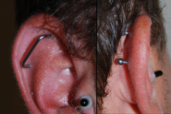 14g-staple-industrial-healed