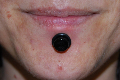 Scalpeled-Labret