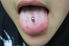 Center-tongue