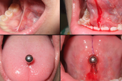 Frenum-cut-and-tongue-pierce