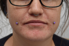 Healed-Anatometal-Cabochon-Cheeks