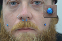 Healed-blue-opal-cheek-anchors