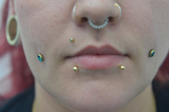 Healed-green-CZ-cheek-anchors