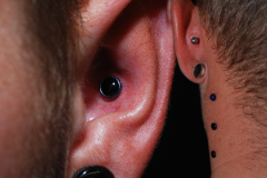 Triple-Anchors-Behind-Lobe