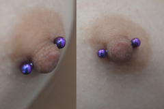 Diagonal-12g-Nipple-Healed