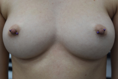 Diagonal-12g-Nipples-Healed