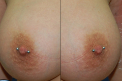 Diagonal-Female-Nipples-healed