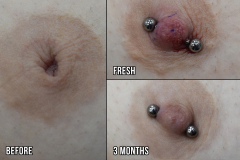 10g-Type-2-Inverted-Nipple-Correction-Healed
