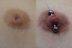 10g-Type-2-Inverted-Nipple-Correction