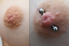 12g-Type-One-Inverted-Nipple