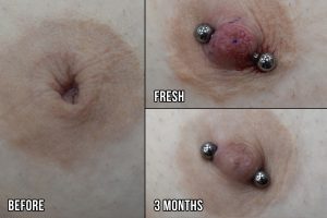 10g-Type-2-Inverted-Nipple-Correction-Healed