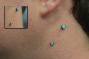 6-year-old-side-neck-anchors