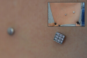 Intrinsic-dermal-tops-healed