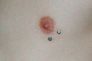 Nipple-anchors-healed