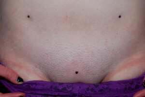 Pubic Mound Anchors