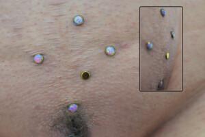 Southern Crotch Anchors