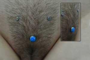 Three pubic mound anchor triangle